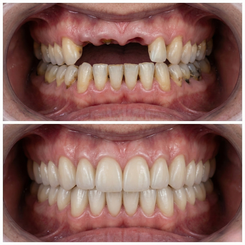 full mouth rehabilitaion kudus