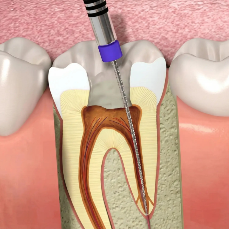 RootCanal Treatment Kudus Dental RT Nagar and Thanisandra Bangalore
